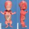 Thanatophoric dysplasia (20 weeks)