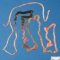 Megacystis-microcolon syndrome (Case #11183)