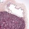 Fetal oligocystic kidneys of unknow cause (case 11389)
