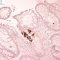 Adenoviral colonic infections