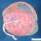 Normal amniotic membrane around the placenta