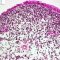 Botryoid embryonal rhabdomyosarcoma of the rhinopharynx