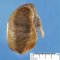 Colonic atresia