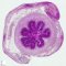 Meconial peritonitis after fetal intestinal perforation in cystic (...)