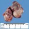 Extralobar pulmonary sequestration