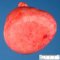 Pulmonary giant cystic chondroid hamartoma