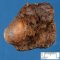 Hashimoto thyroiditis with nodular hyperplasia