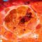 Macronodular cirrhosis and hepatocellular carcinoma in tyrosinemia