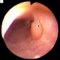 Intestinal infantile myofibromatosis