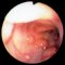 Intestinal infantile myofibromatosis