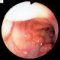 Intestinal infantile myofibromatosis