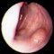 Intestinal infantile myofibromatosis