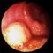 Intestinal infantile myofibromatosis