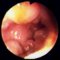 Intestinal infantile myofibromatosis