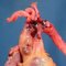 Dissection of proximal ascending thoracic aorta in Marfan disease