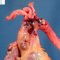 Dissection of proximal thoracic aorta in Marfan disease