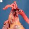 Dissection of proximal thoracic aorta in Marfan disease