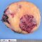 Nodular ganglioneuroblastoma