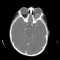 Orbital embryonal rhabdomyosarcoma