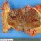 Renal oncocytoma
