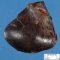 Testicular infarction by spermatic cord torsion