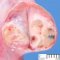 testicular juvenile-type granulosa tumor