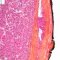 Thyroid oncocytic carcinoma