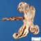 Unilateral multicystic renal dysplasia