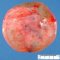 Ovarian cystic mature teratoma