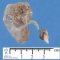 Renal adysplasia