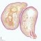 Polydactyly: supernumerary finger