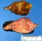 Adrenal pheochromocytoma