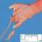 Fetal hand with amniotic bands (22 weeks)