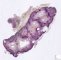 Fetal obstructive kidney 19 weeks