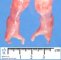 Hand ectrodactyly