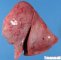 Subpleural hemorrhages in systemic fungal dissemination