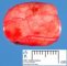 Intradural extramedullary schwannoma