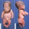 Thanatophoric dysplasia