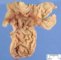 Meckel diverticula