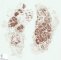 Lobular capillary hemangioma