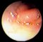 Intestinal infantile myofibromatosis