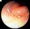 Intestinal infantile myofibromatosis