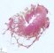 Lymphangiomyoma (lymphangioleiomyoma)