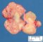 Mycobacterial adenitis