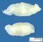 Neurofibroma