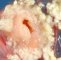 Ovarian mature teratoma (dermoid cyst)