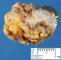 Thyroglossal tract cyst