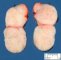 Thyroid teratoma