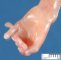Bilateral cleft lip/palate, omphalocele, postaxial polydactyly in trisomy (...)
