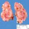 Nodal invasion by a neuroblastoma